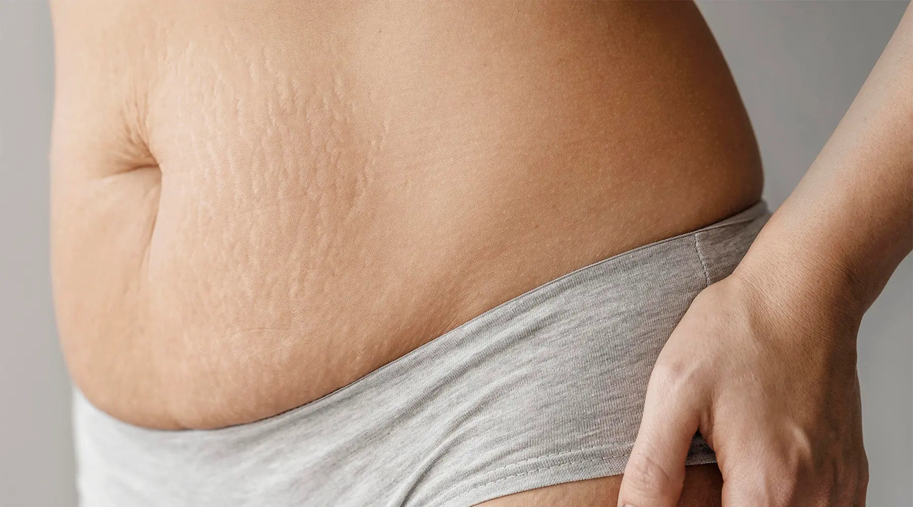 ¿Cómo combatir la celulitis?